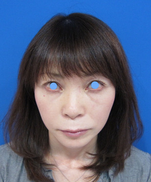 目の下のたるみ、目のくまでお悩みの方、切らずに完璧に解決します。TCB-R法　手術直後　症例写真